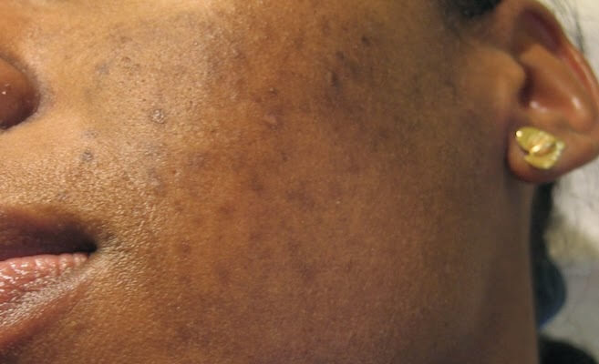 Peau noire : 10 sérums réputés efficaces contre les taches et cicatrices d’acné