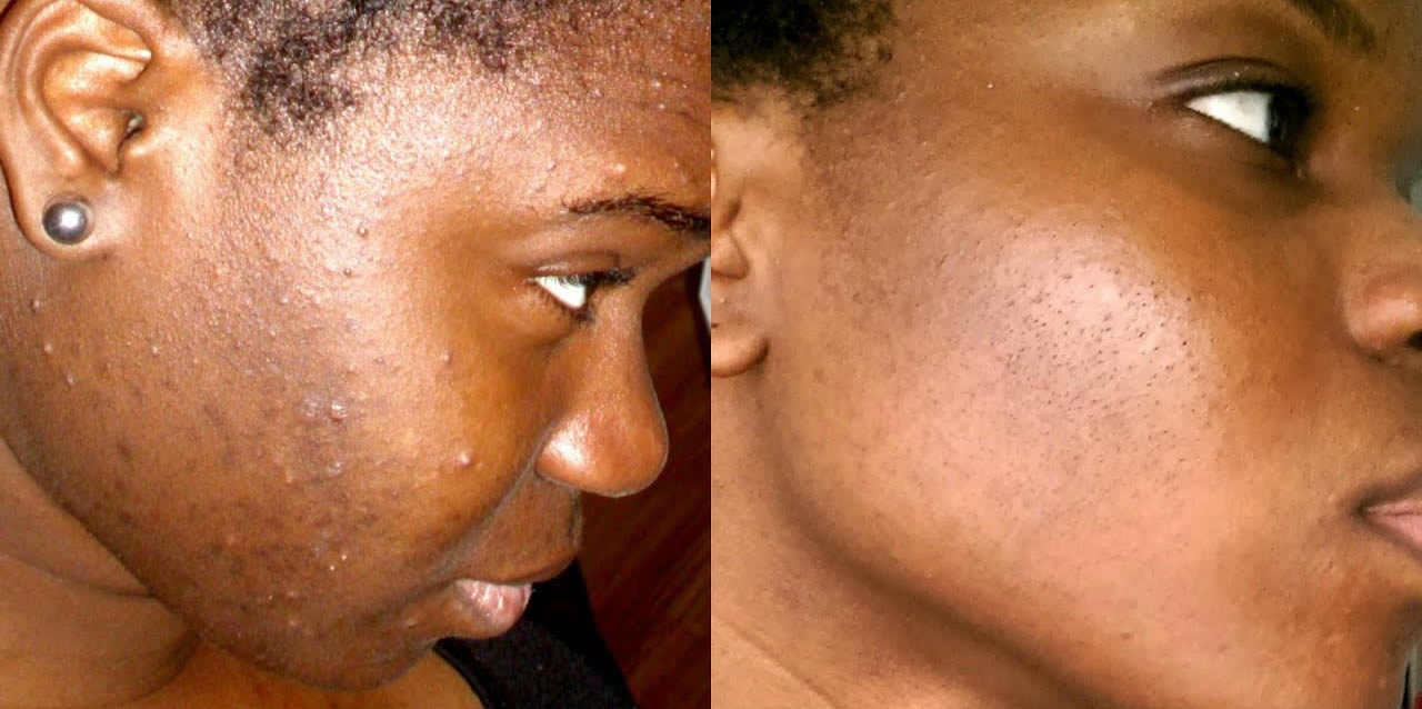Comment éliminer les taches pigmentaires sur une peau noire ?